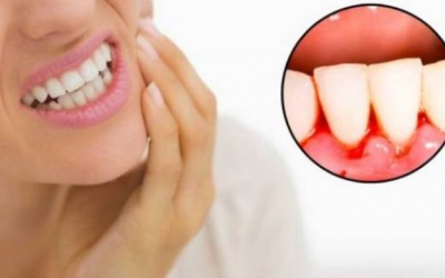 Chảy máu chân răng cảnh báo bệnh gì?