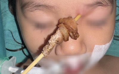 Bé gái 2 tuổi suýt mù mắt, tổn thương não khi ăn thịt xiên nướng