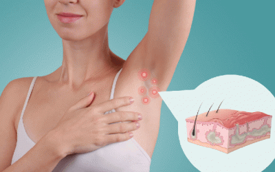 Sống chung với viêm tuyến mồ hôi mủ trong mùa Hè