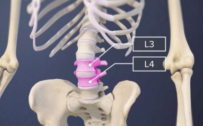 Dấu hiệu nhận biết thoát vị đĩa đệm L3 L4