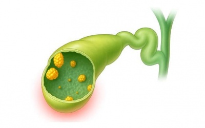 Polyp túi mật 14mm có nguy hiểm không?