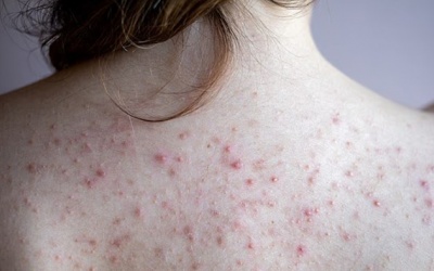 Bị mụn lưng phải làm sao?