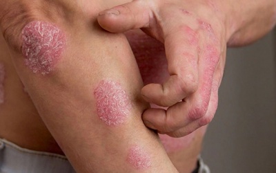 Bị vảy nến có chữa được không?