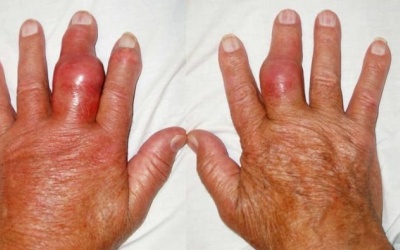 Hạt tophi xuất hiện ở người bệnh gout: Cảnh báo không nên chủ quan