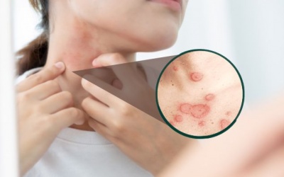 Lupus ban đỏ dạng đĩa có nguy hiểm không? 