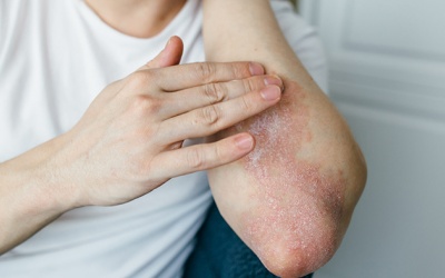 Nguyên nhân nào khiến vảy nến lan ra toàn thân?