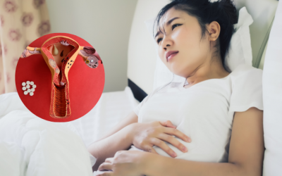 Đột phá điều trị lạc nội mạc tử cung bằng sóng cao tần