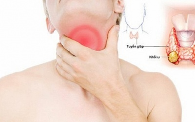 Có những loại bướu tuyến giáp nào?