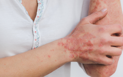 Những hiểu lầm khiến người bệnh vảy nến thêm tự ti