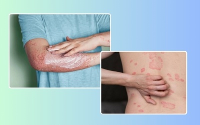Mẹo chăm sóc da cho người bệnh vảy nến thể mảng