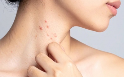 Hướng đi mới giúp kiểm soát bệnh lupus ban đỏ từ thảo dược tự nhiên