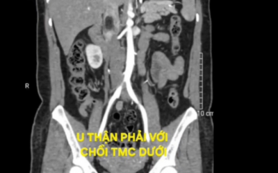 Tình cờ phát hiện u thận kèm huyết khối tĩnh mạch chủ
