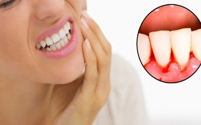 Bị viêm quanh răng có nguy hiểm không?