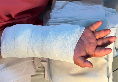 Nối lại bàn tay đứt lìa cho sản phụ, sau 2 tháng được 'ghép tạm' vào chân