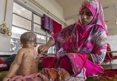 Bangladesh: Gần 100 trẻ em tử vong nghi do dịch sởi bùng phát