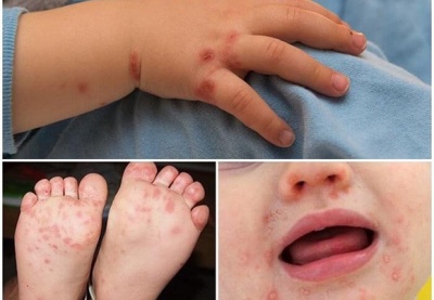 Sốt xuất huyết và tay chân miệng cùng gia tăng mạnh