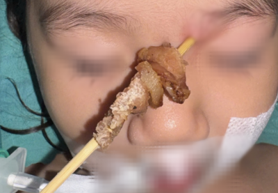 Bé gái 2 tuổi suýt mù mắt, tổn thương não khi ăn thịt xiên nướng