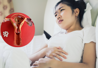 Đột phá điều trị lạc nội mạc tử cung bằng sóng cao tần