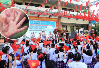 Bộ Y tế cảnh báo gia tăng bệnh tay chân miệng trong mùa tựu trường