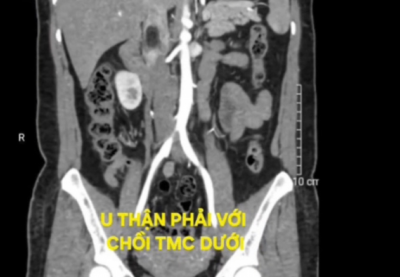 Tình cờ phát hiện u thận kèm huyết khối tĩnh mạch chủ