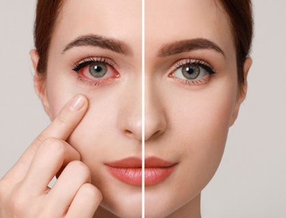 Sai lầm cần tránh khi bị đau mắt đỏ