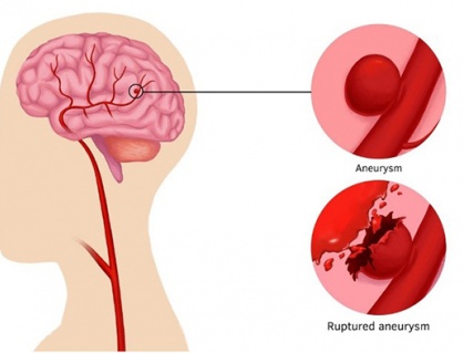 Dấu hiệu tiềm ẩn cảnh báo bệnh phình động mạch não