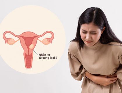 Cách kiểm soát nhân xơ tử cung loại 2 để tránh biến chứng