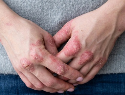 Giải pháp cho người vảy nến đang điều trị bệnh dạ dày