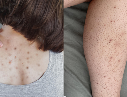 Giải pháp giúp làn da cơ thể mịn màng, hết mụn