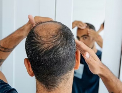 Nam giới bị rụng tóc nên ngừng loại đồ uống nào?