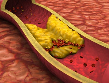 5 cách cải thiện mỡ máu cao hiệu quả
