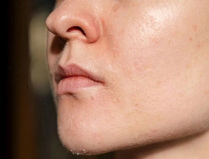 Cần làm gì khi da mặt bị bong tróc vào trời lạnh?