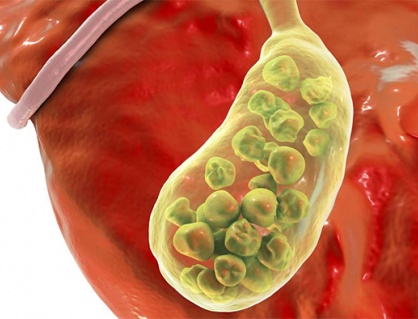 Có đám sỏi mật 27mm phải làm sao?