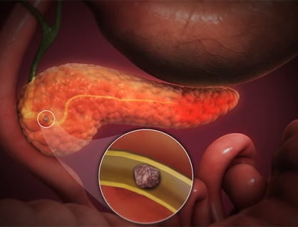 Có sỏi ống tụy 12mm cần xử trí thế nào để kiểm soát bệnh?