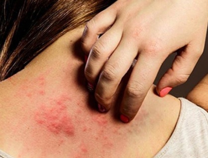 Vì sao bệnh vảy nến trở nặng khi trời lạnh?