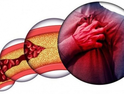 Mỡ máu cao - “thủ phạm” gây đột quỵ, nhồi máu cơ tim