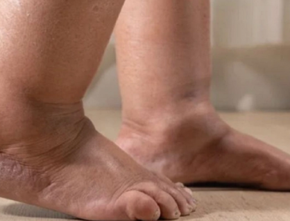 Sưng tấy bàn chân kéo dài cảnh báo dấu hiệu bệnh lý gì?