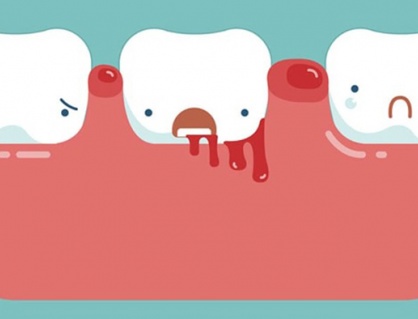 Cách cải thiện tình trạng chảy máu chân răng