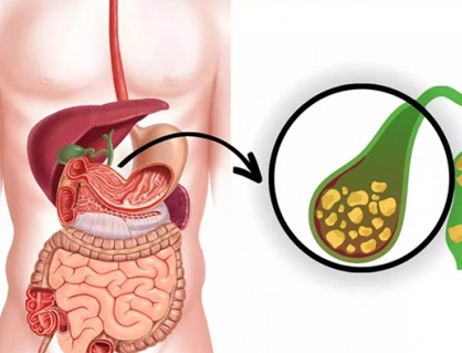 Sỏi túi mật 7,5mm có nguy hiểm không?