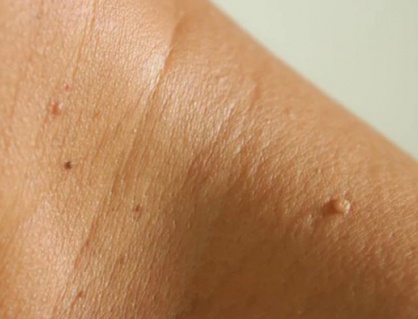 5 dấu hiệu cảnh báo bệnh đái tháo đường bạn không nên bỏ qua