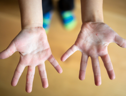 Cha mẹ cần cảnh giác với bệnh tay chân miệng ở trẻ