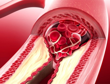 Hẹp mạch vành do vôi hóa khác gì do mảng bám cholesterol?