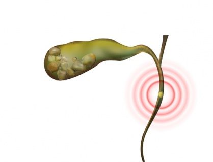 Có sỏi ống mật chủ 36x12mm: Dùng TPBVSK Kim Đởm Khang được không?