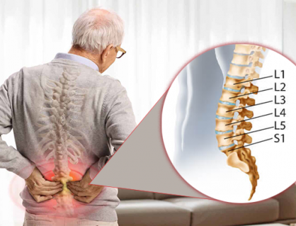 Dấu hiệu nhận biết thoái hóa đốt sống lưng L5 S1 không nên bỏ qua