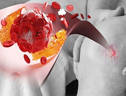 Yoga có giúp kiểm soát acid uric cao không?