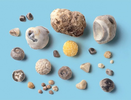 Sỏi mật 7mm: Dùng TPBVSK Kim Đởm Khang được không?