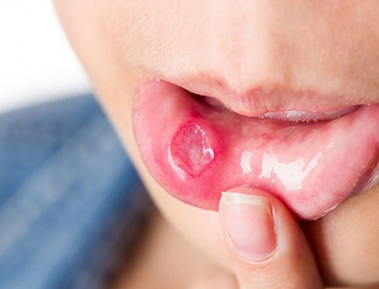 Dấu hiệu ở miệng chứng tỏ bạn thiếu vitamin B12