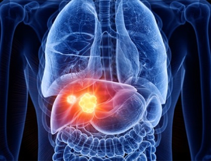 Sỏi đường mật trong gan có nguy hiểm không, nên xử trí thế nào?