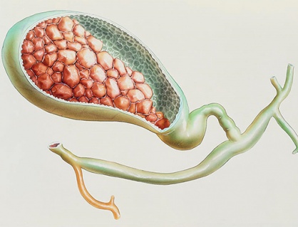 Sỏi mật 8,9mm và 15mm chưa có biến chứng có nguy hiểm không?