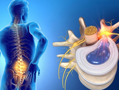 7 nguyên nhân dẫn đến thoát vị đĩa đệm